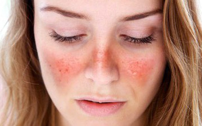 Lupus ban đỏ ở phụ nữ