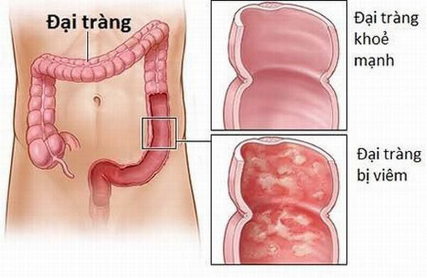 : BoniBaiO+ sản phẩm hỗ trợ giảm các triệu chứng do viêm đại tràng gây ra