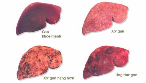 ung thư gan giai đoạn cuối sống được bao lâu