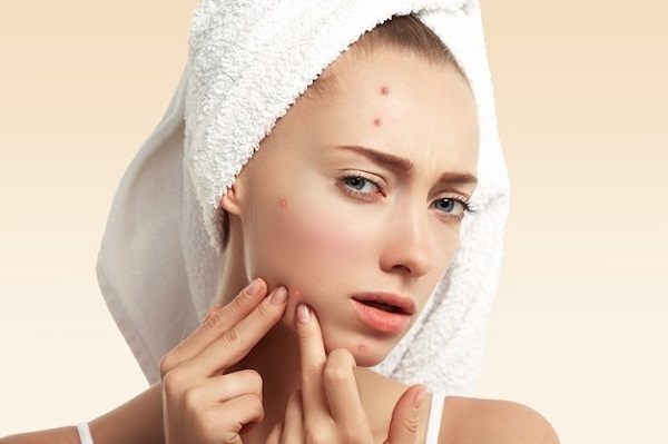 càng skincare càng lên mụn