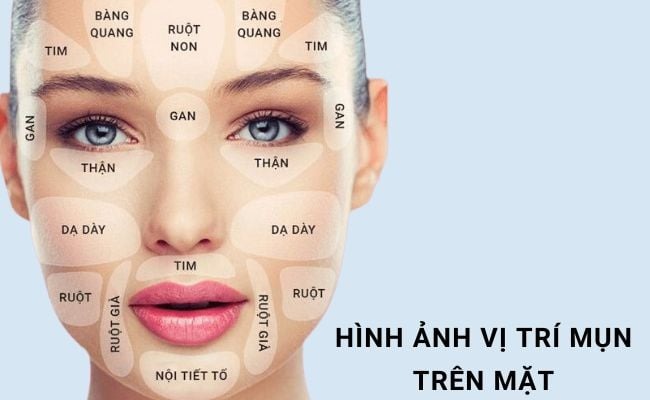 mụn mọc cố định ở 1 vị trí