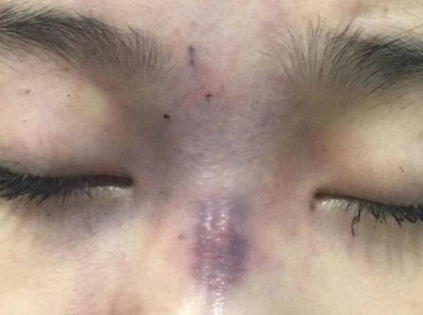 Biến chứng do tiêm filler và cách xử trí