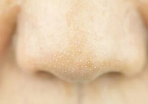 Mụn cám là gì? Nguyên nhân và cách trị tận gốc tại nhà