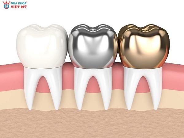 Giá bọc răng sứ kim loại