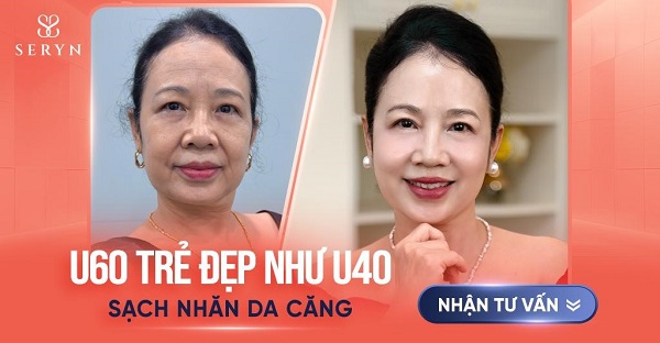 cách xóa nhăn trên mặt