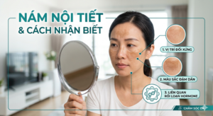 Nám nội tiết và cách nhận biết